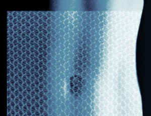 Surgical Mesh Implant - Learn Hernia Mesh Implant Laws